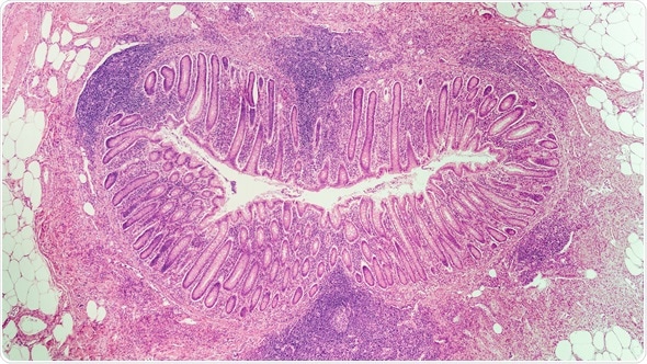 Microscopic image (photomicrograph) of a cross section of an appendix in a child with acute appendicitis. Image Copyright: David Litman / Shutterstock